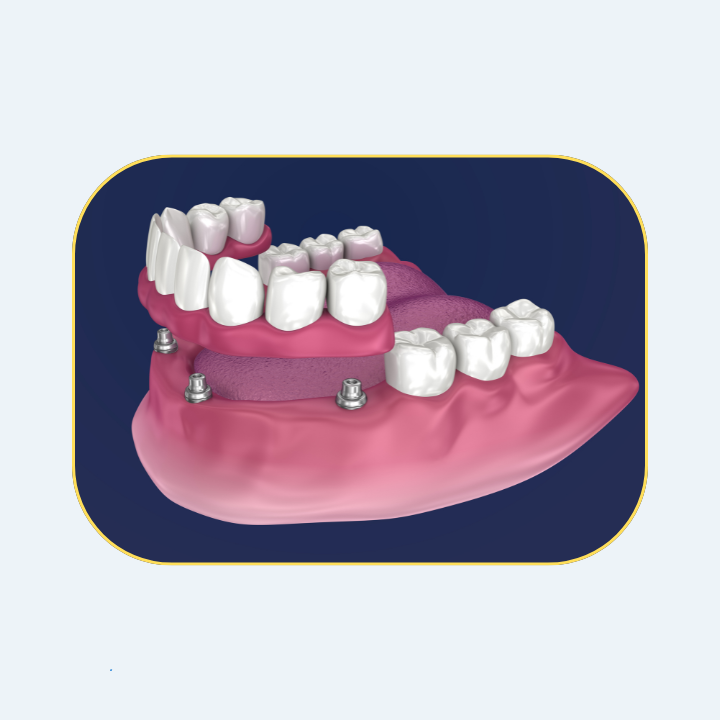 Snap On Denture | West Covina Dental
